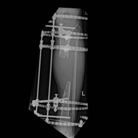 X-rays show limb reconstruction is required