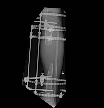 X-rays show limb reconstruction is required