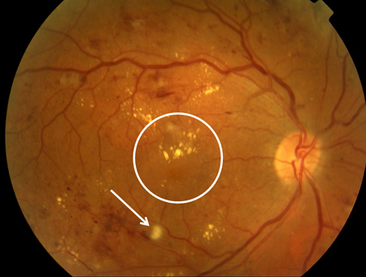 Maculopathy requiring hospital eye service.