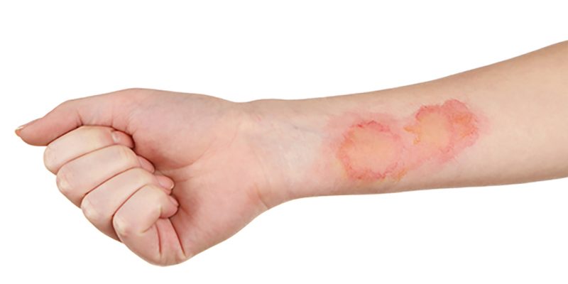 Image showing a burn to the inner arm