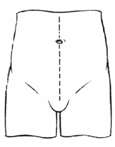 Line diagram of the abdomen. A dashed line starting at the top of the pubic hairline going straight up above the belly button, illustrates where the incision may occur