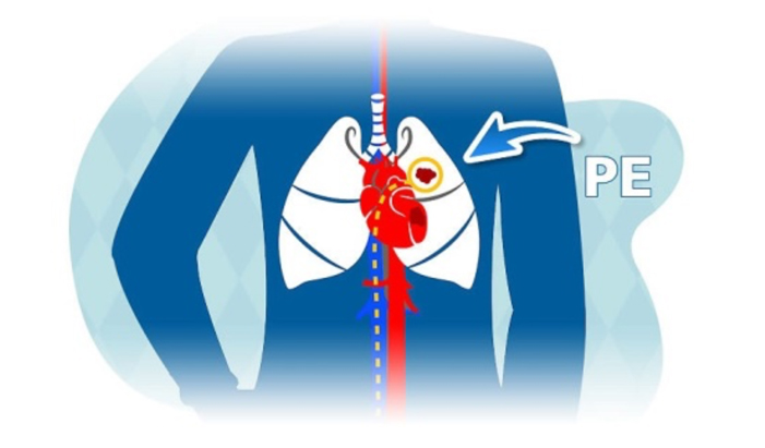 Diagram highlighting the lungs pointing to area where a PE could occur.