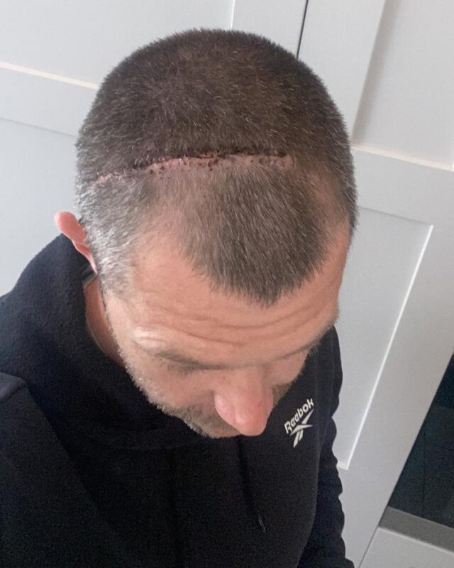 Chris Neal craniotomy scar