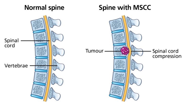 Side-by-side diagram of a normal spine and a spine with Metastatic Spinal Cord Compression (MSCC). The normal spine shows vertebrae with a healthy spinal cord. The spine with MSCC shows a tumour pressing against the spinal cord, causing spinal cord compression.