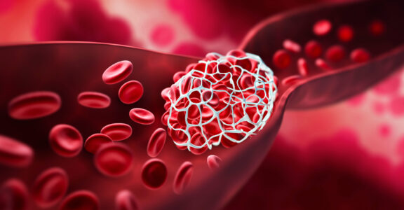 Blood clot blocking a blood vessel