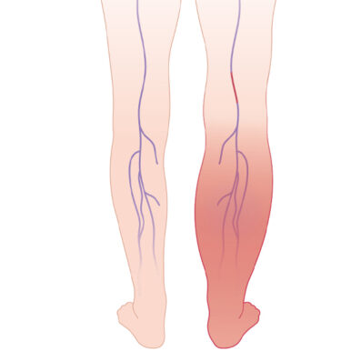 Deep Vein Thrombosis showing the blockage and a swollen red leg