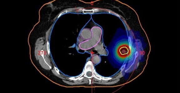 Radiotherapy lung treatment plan