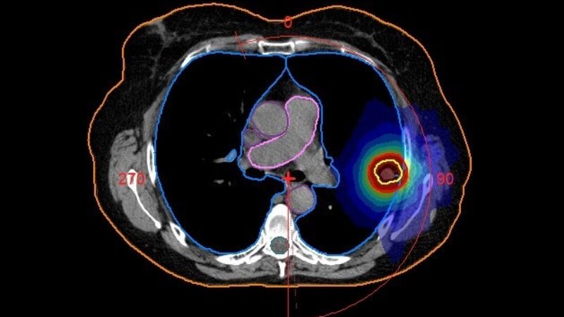 Radiotherapy lung treatment plan